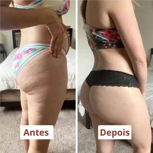 DrenaRoller Massageador Linfático para Lipedema e Celulite